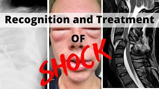 Recognition and Treatment of Shock [upl. by Januisz475]